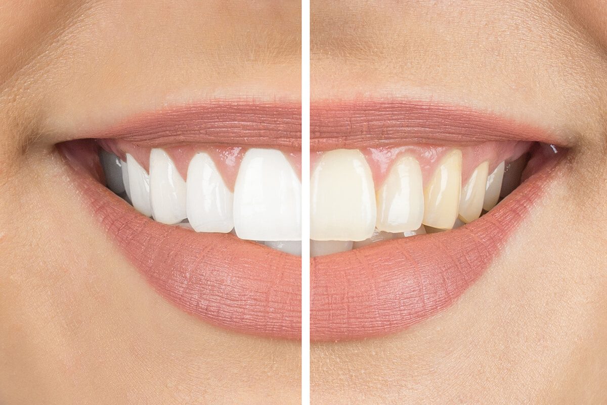 A close-up of a person's smile showing a split image comparison: the left side with whiter teeth and the right side with slightly yellowed teeth.